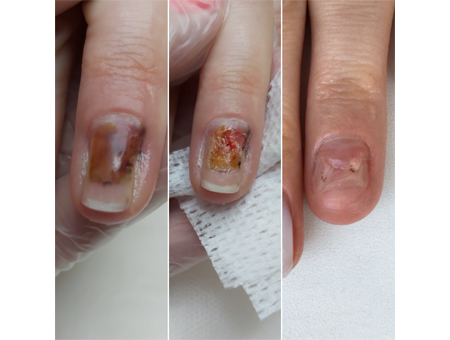 обработка и лечение травмированных ногтей в Мытищах