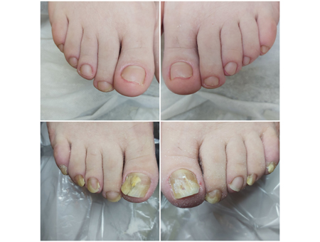 лечение грибка ногтей и кожи в Мытищах