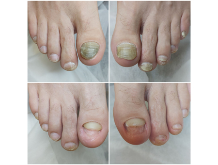 лечение грибка ногтей и кожи в Мытищах
