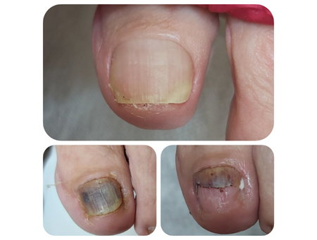 обработка и лечение травмированных ногтей в Мытищах
